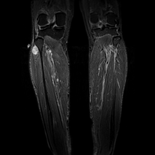 Figure 3 for case Schwannoma ( RID4473 )